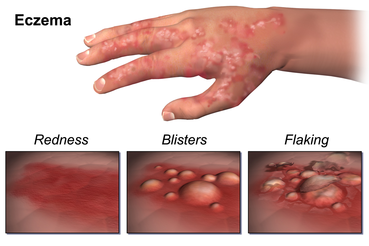 Prevention of eczema in infancy using daily emollient therapy