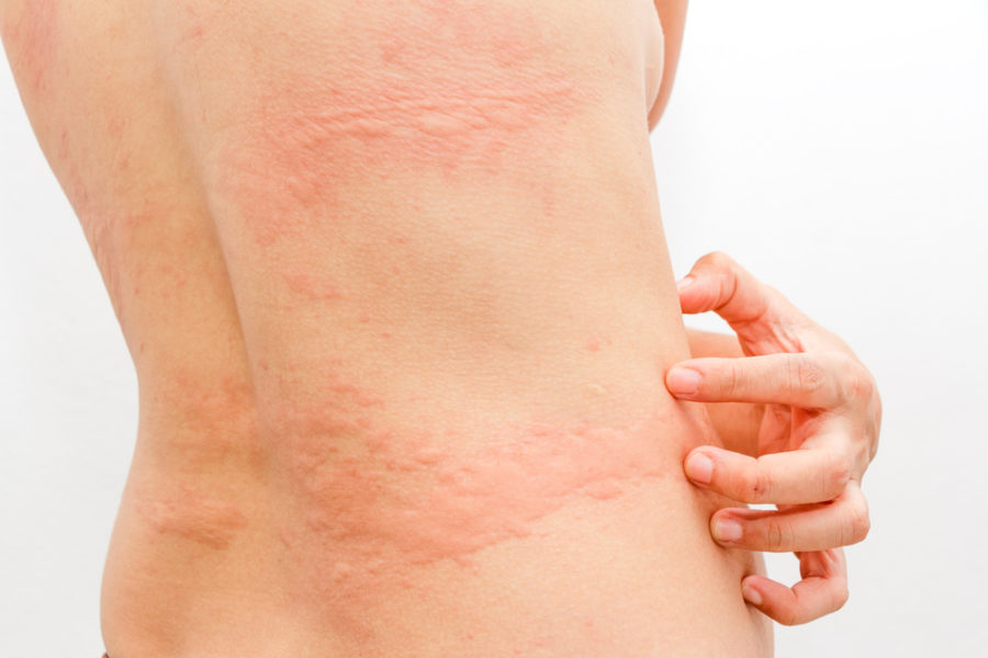 Hives/ Urticaria/ Itchy Skin Family Allergy